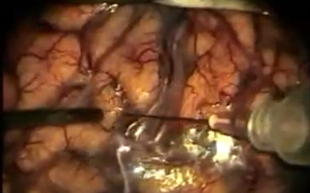 90's- Art of Surgery of Brain Arteriovenous Malformations
