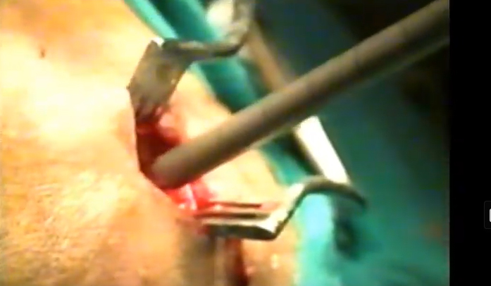 Colloid Cyst Excision