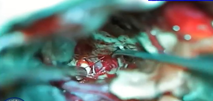 Mesial Temporal Lobe Glioma