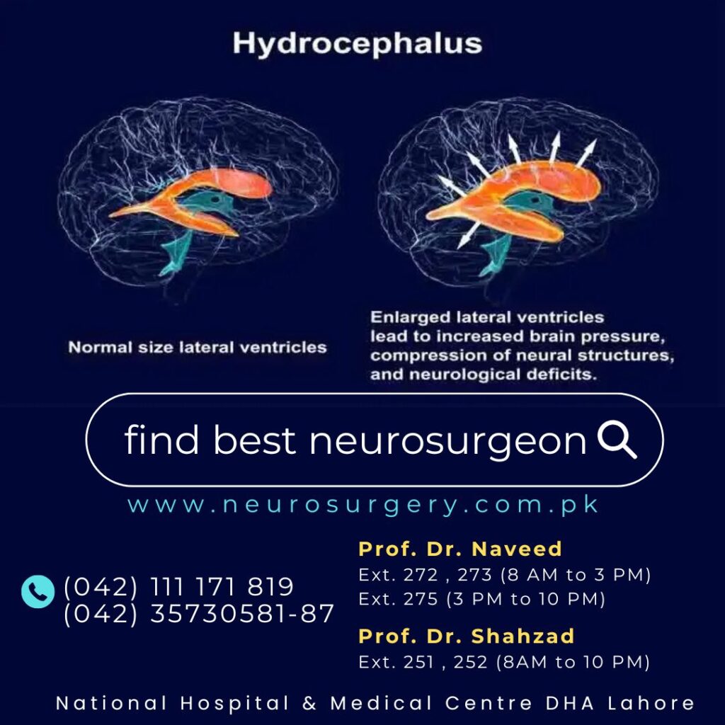 Hydrocephalus - neurosurgeon in dha lahore pakistan