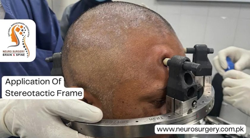 Stereotactic Biopsy of Pineal Region SOL Under Local Anesthesia