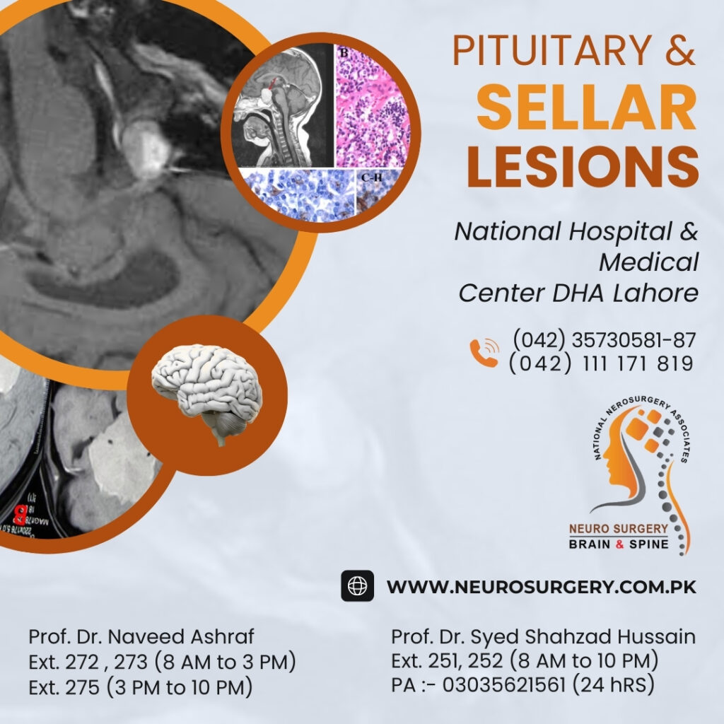 pituitary and sellar lesions - best neurosurgeon in dha lahore pakistan