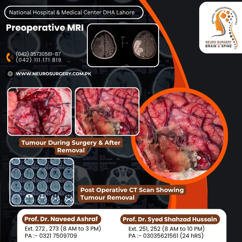 brain tumour during surgery and after removal brain tumour- preopeative MRI
